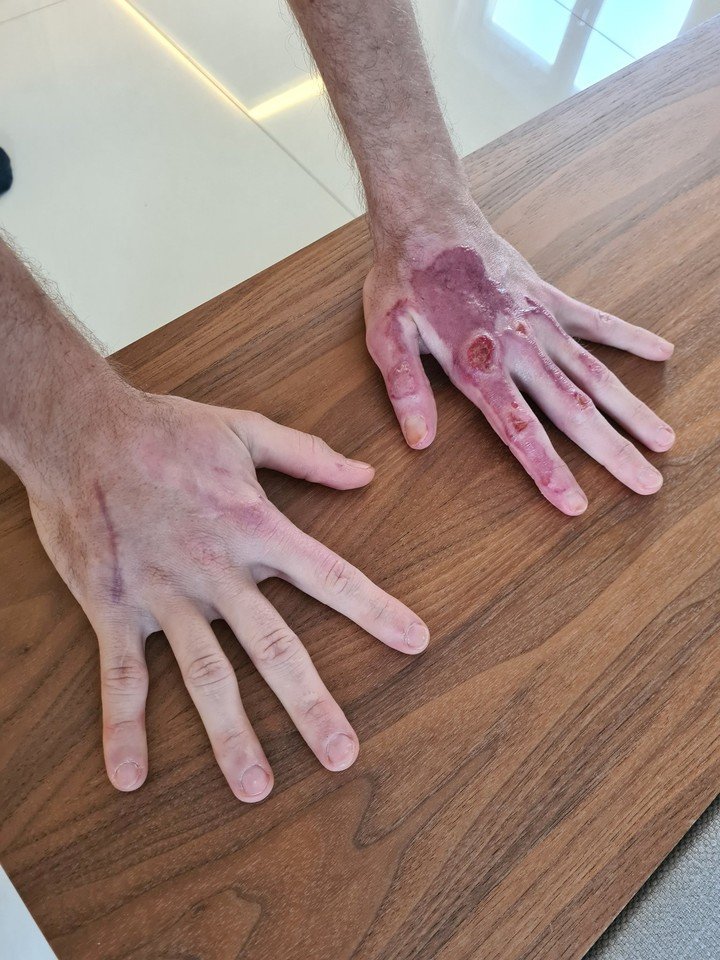 Las manos quemadas de Grsojean.